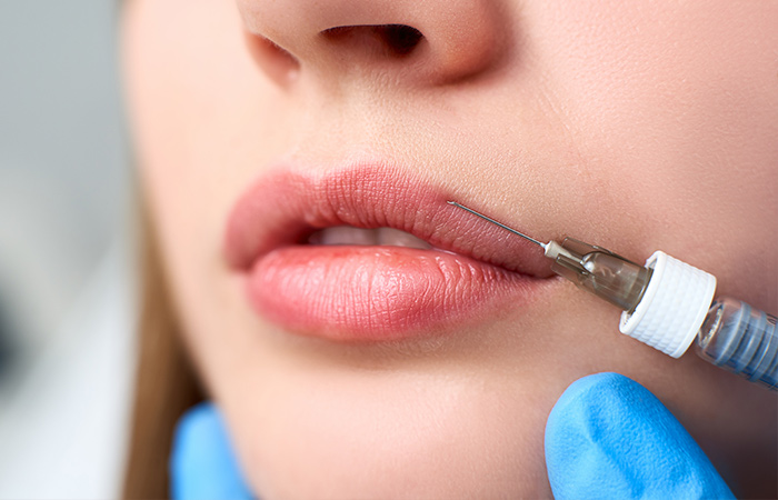 Aesthetics treatments in Oxford. Dermal fillers. Needle injecting dermal filler into woman's lips.